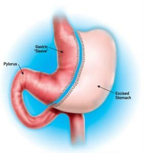 gastric sleeve